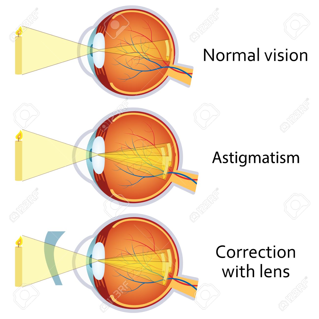 vision borrosa de un ojo