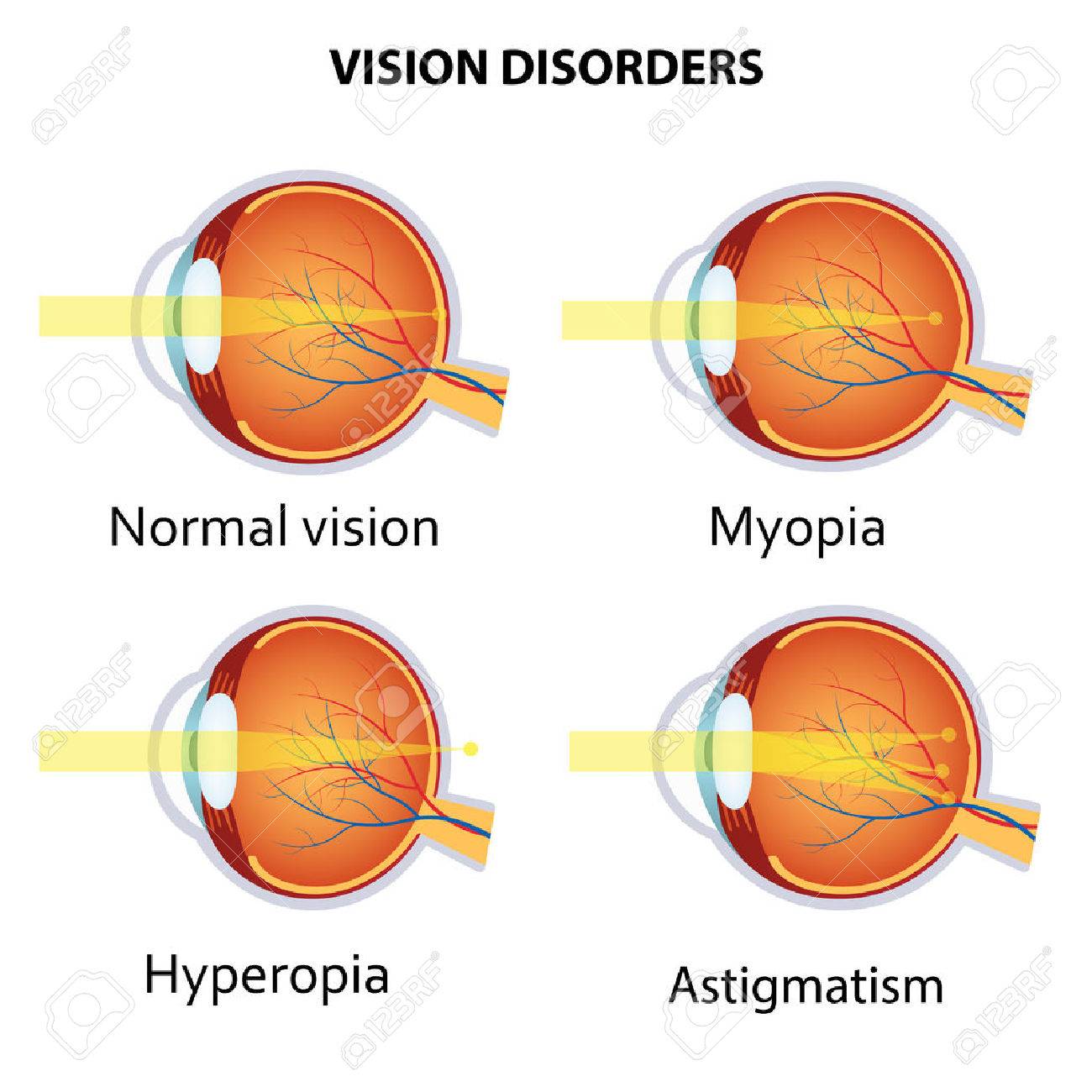 ostigmatism de miopie