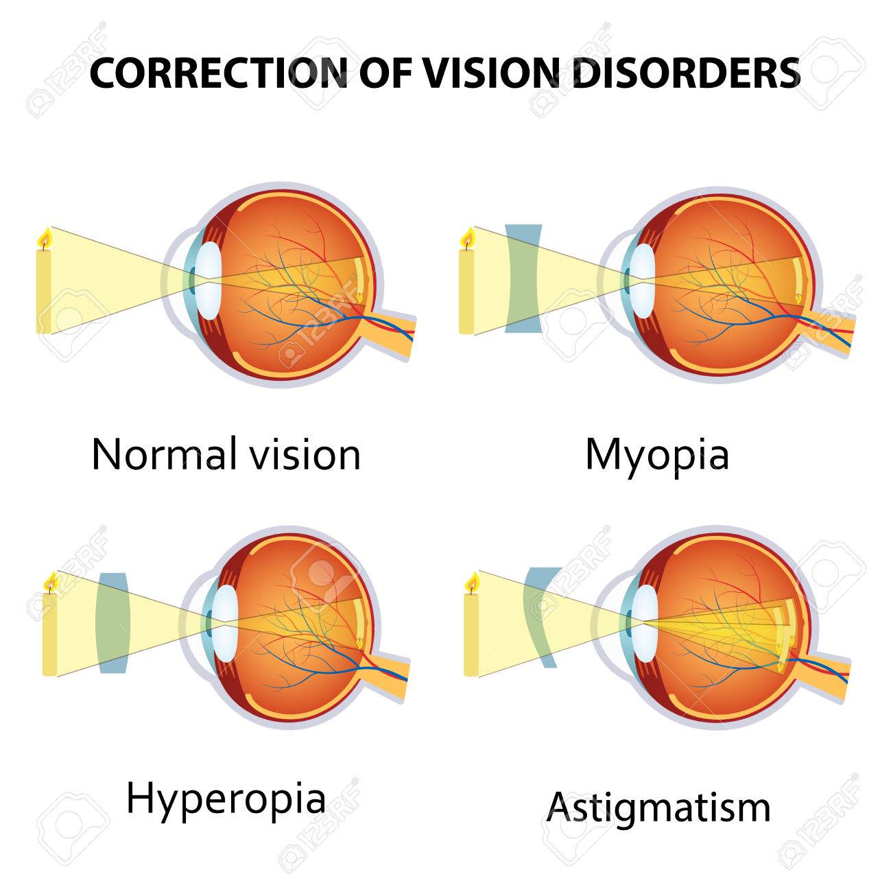 hyperopia myopia norma a látásom mínusz 20