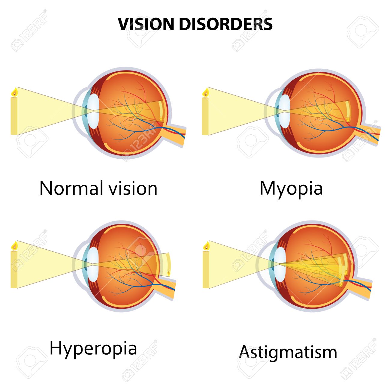 myopia myopia astigmatismus