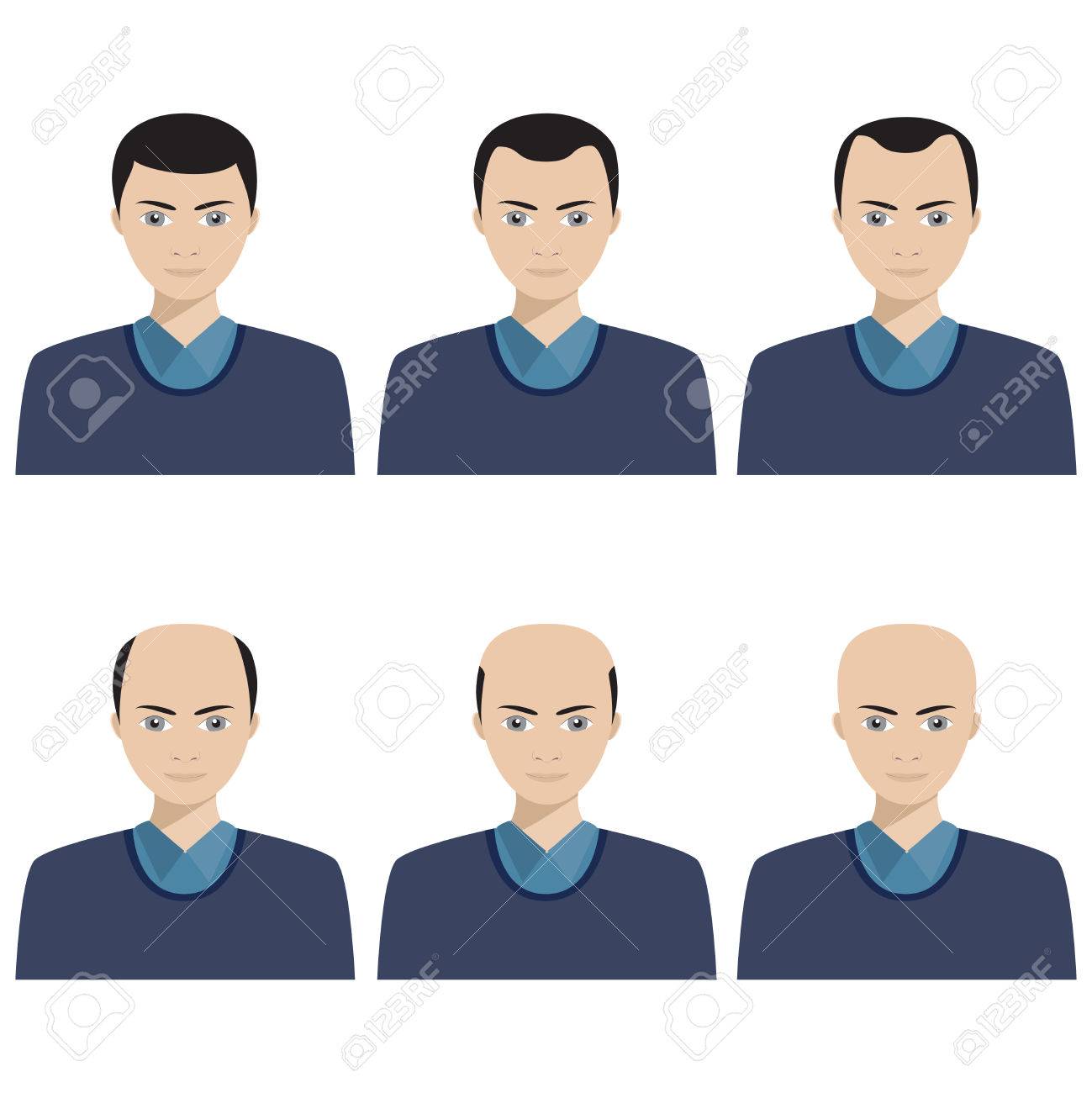 Hair Loss Stages And Types Of Baldness Illustrated On A Male