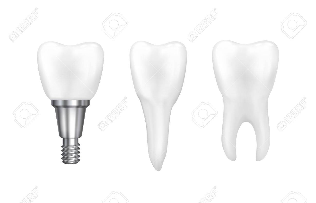 tooth implants and normal tooth isolated on white background
