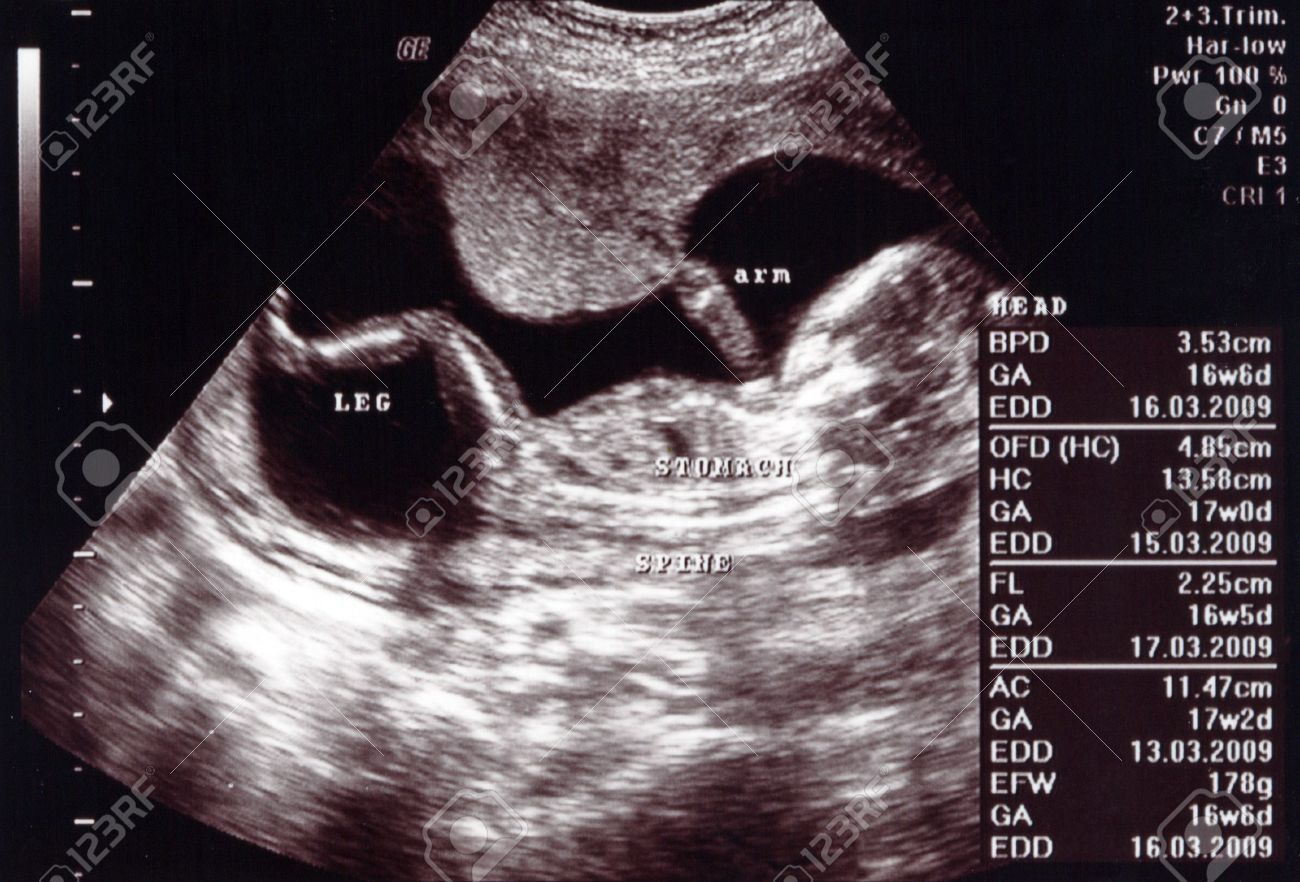 Ultrasound Scan 17 Weeks Stock Photo Picture And Royalty Free Image Image 3777440