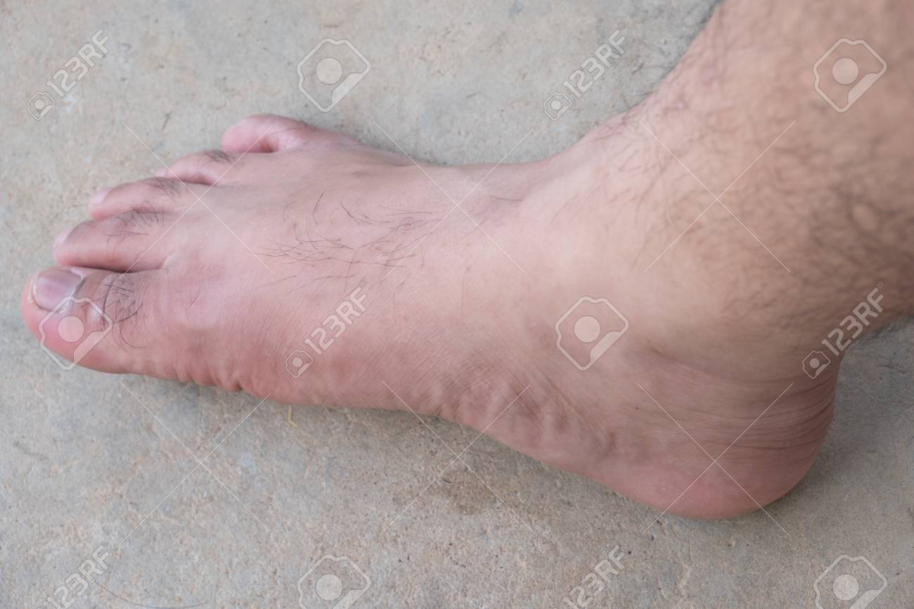 Încărcarea pentru varicose feet video - Cum de a vindeca mai bine varicarea pe picioare