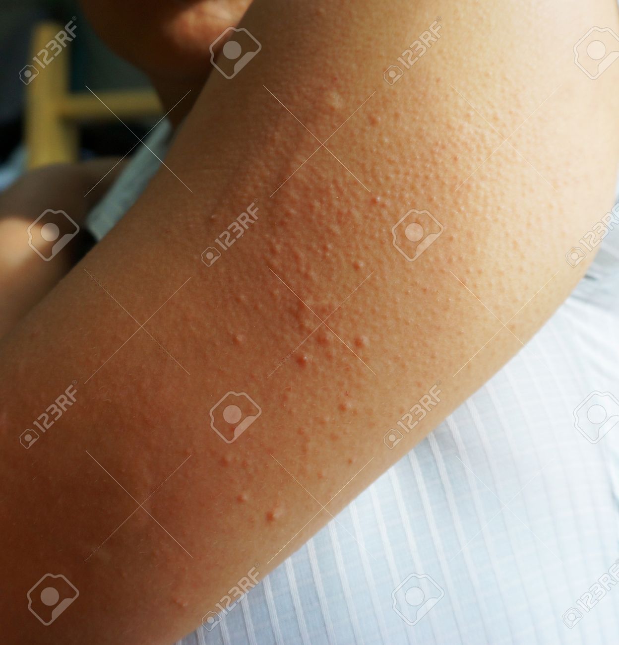 アレルギー性発疹皮膚炎 かゆみ 発赤 患者の皮膚の腕で の写真素材 画像素材 Image アレルギー性発疹皮膚炎 かゆみ 発赤 患者の皮膚の腕で の写真素材 画像素材 Image