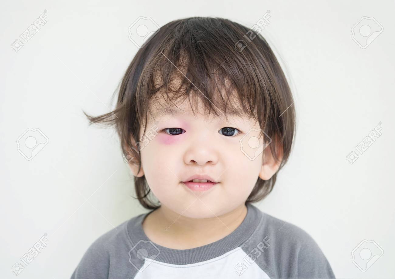 Immagini Stock Primo Piano Gonfi Occhi Di Bambino Da Morso Di Insetto Con Livido Rosso Ma Lui Puo Sorridere Image