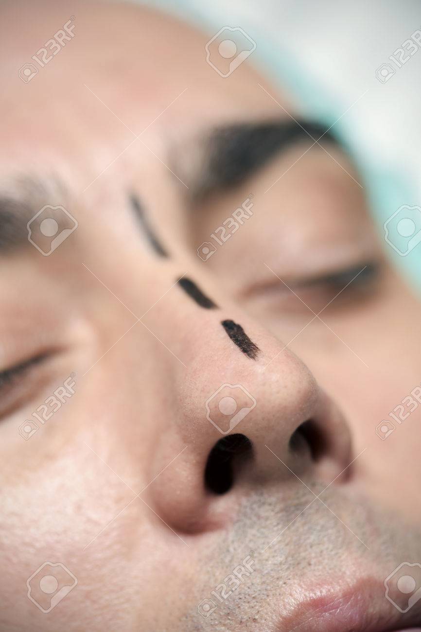 closeup of the head of a young caucasian man who is about to have a rhinoplasty, wearing a medical disposable cap and with surgery lines marked in his nose - 77712648 closeup of the head of a young caucasian man who is about to have a rhinoplasty, wearing a medical disposable cap and with surgery lines marked in his nose - 77712648