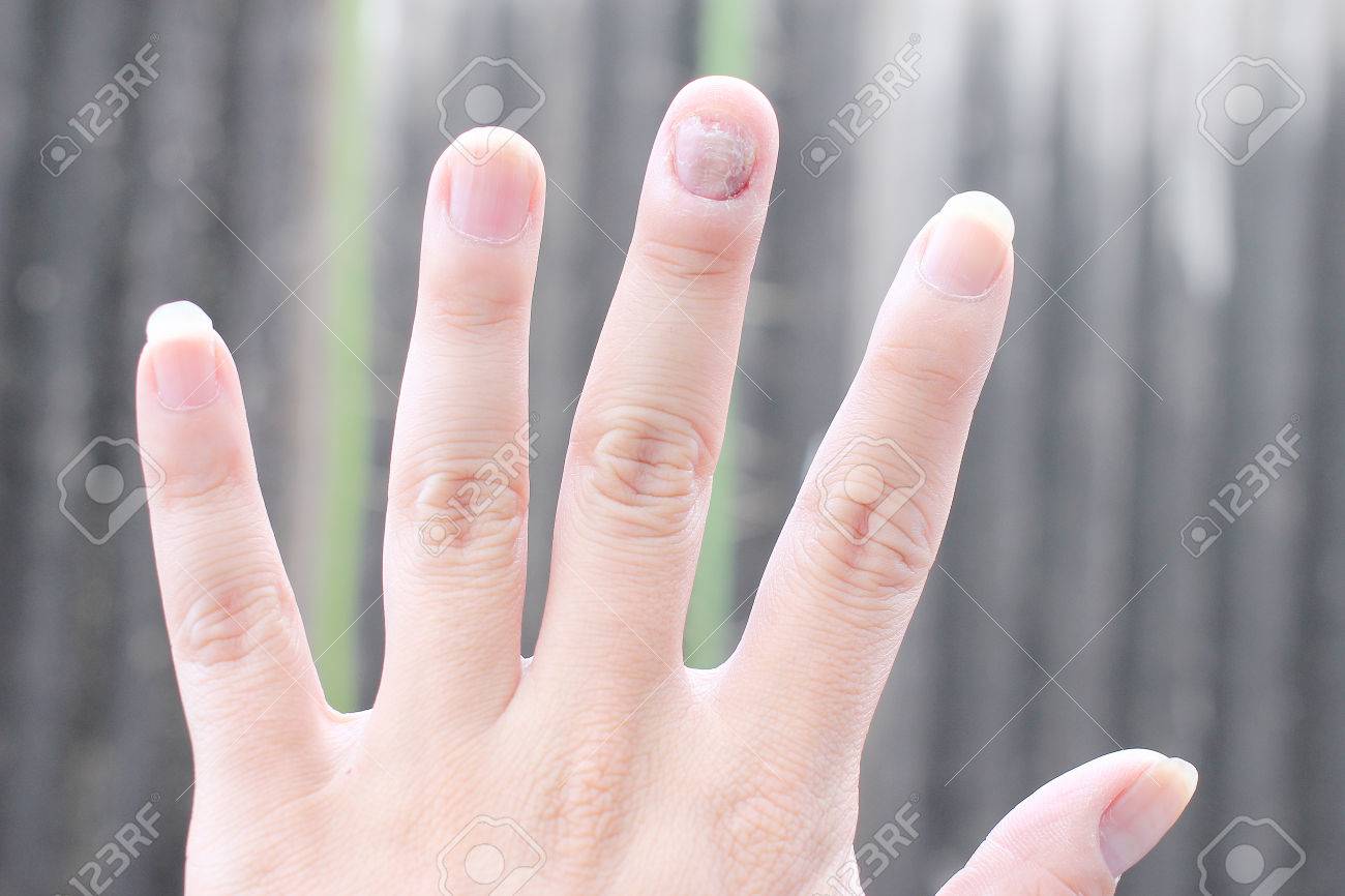Fungus Infection On Nails Hand Finger With Onychomycosis Stock Photo Picture And Royalty Free Image Image Fungus Infection On Nails Hand Finger With Onychomycosis Stock Photo Picture And Royalty Free Image Image