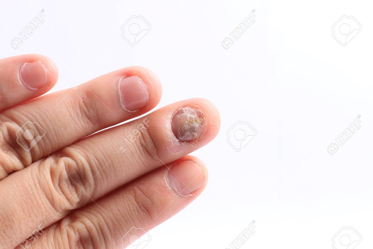 手の爪 爪真菌症指 白い背景の上の爪 Handisolated の真菌感染症の真菌感染症 の写真素材 画像素材 Image