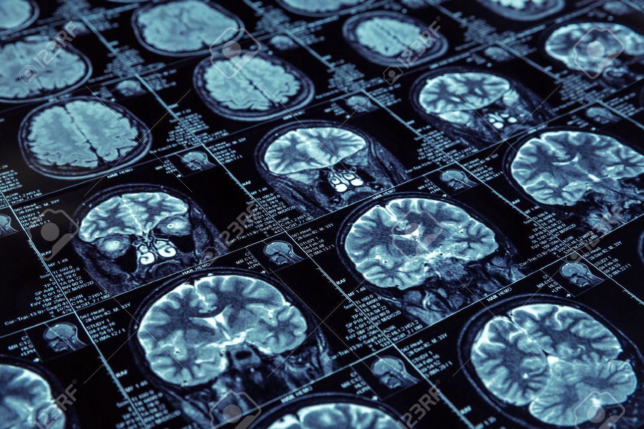 Closeup of X-ray photography of human brain - 55007795 Closeup of X-ray photography of human brain - 55007795