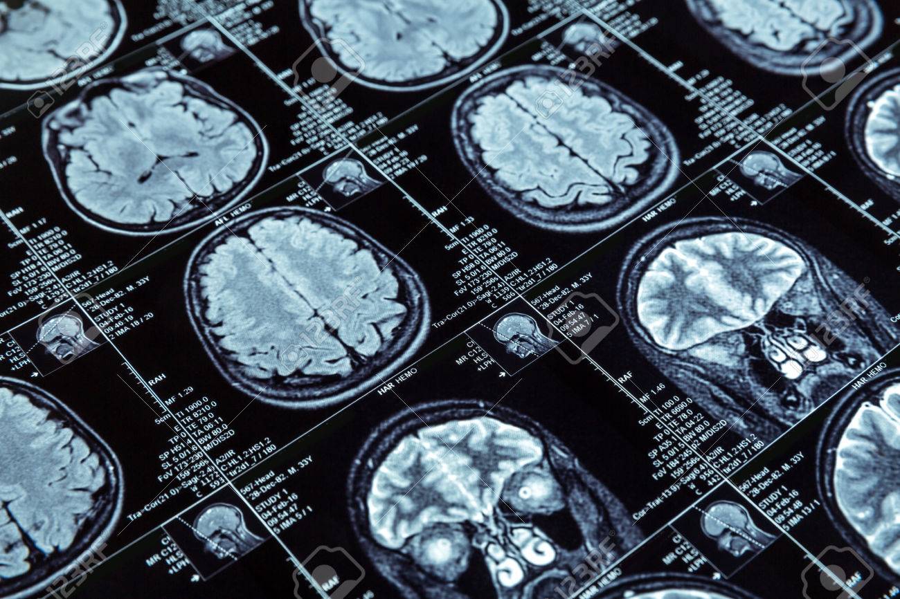 Closeup of magnetic resonance imaging photography of human brain - 56351954 Closeup of magnetic resonance imaging photography of human brain - 56351954