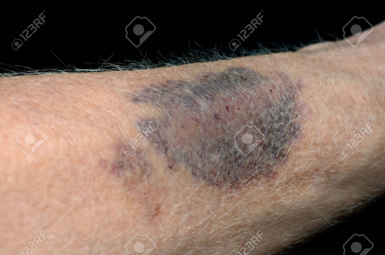 腕に大きなあざ の写真素材 画像素材 Image 2465