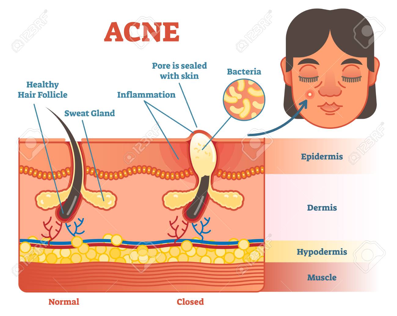 Acne Causes Chart