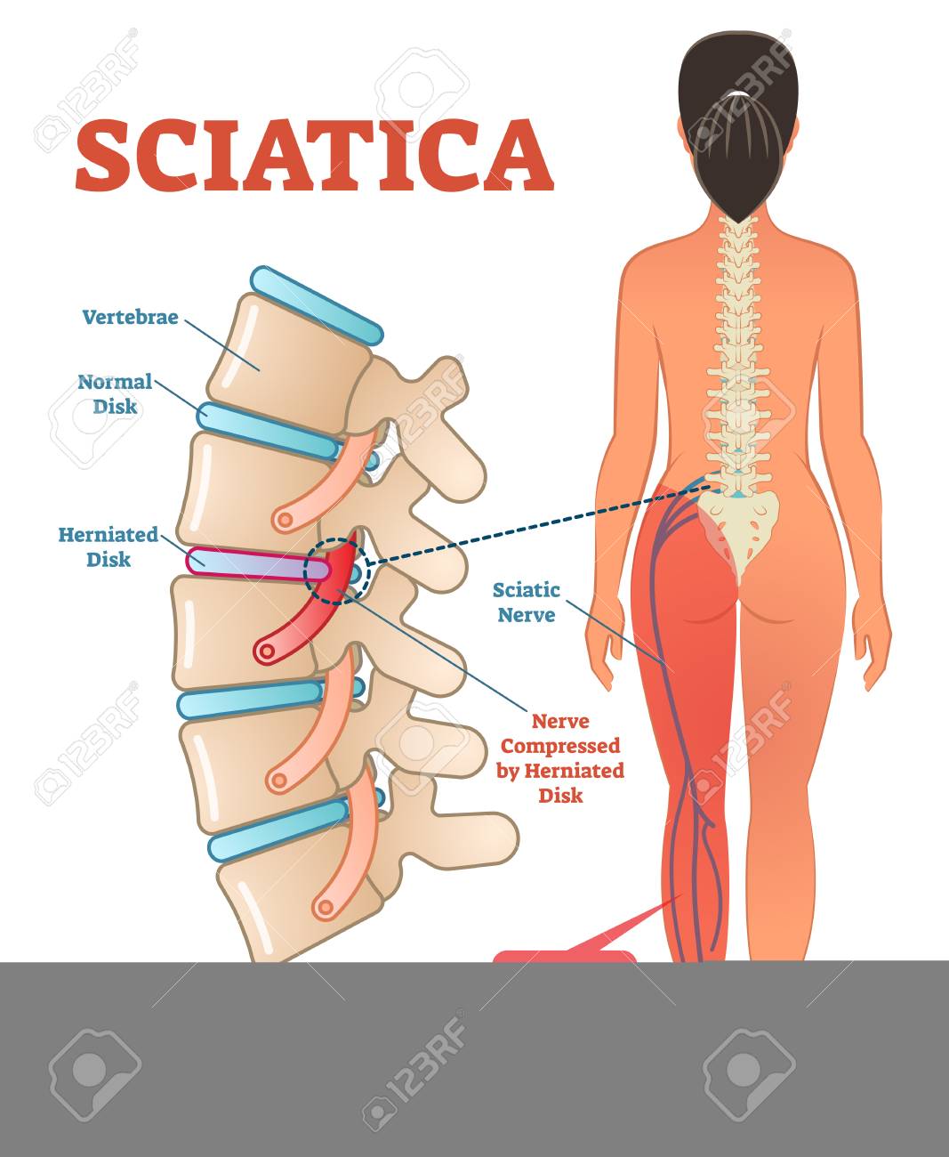 Ciático inferior la nervio pierna de