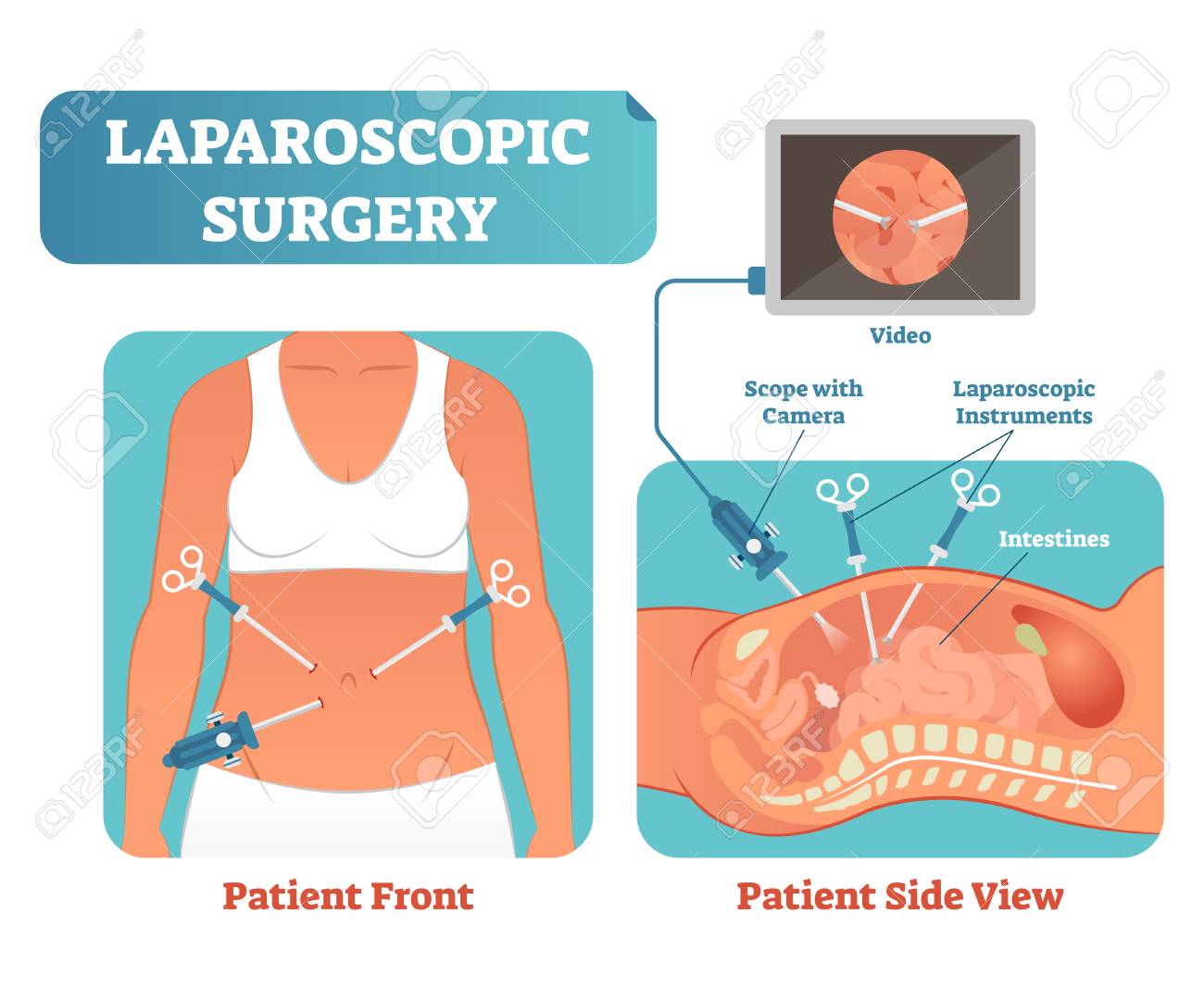 Laparoscopic surgery medical health care surgical procedure process, anatomical cross section vector illustration diagram. Laparoscopy instruments with camera and screen. - 101059224 Laparoscopic surgery medical health care surgical procedure process, anatomical cross section vector illustration diagram. Laparoscopy instruments with camera and screen. - 101059224
