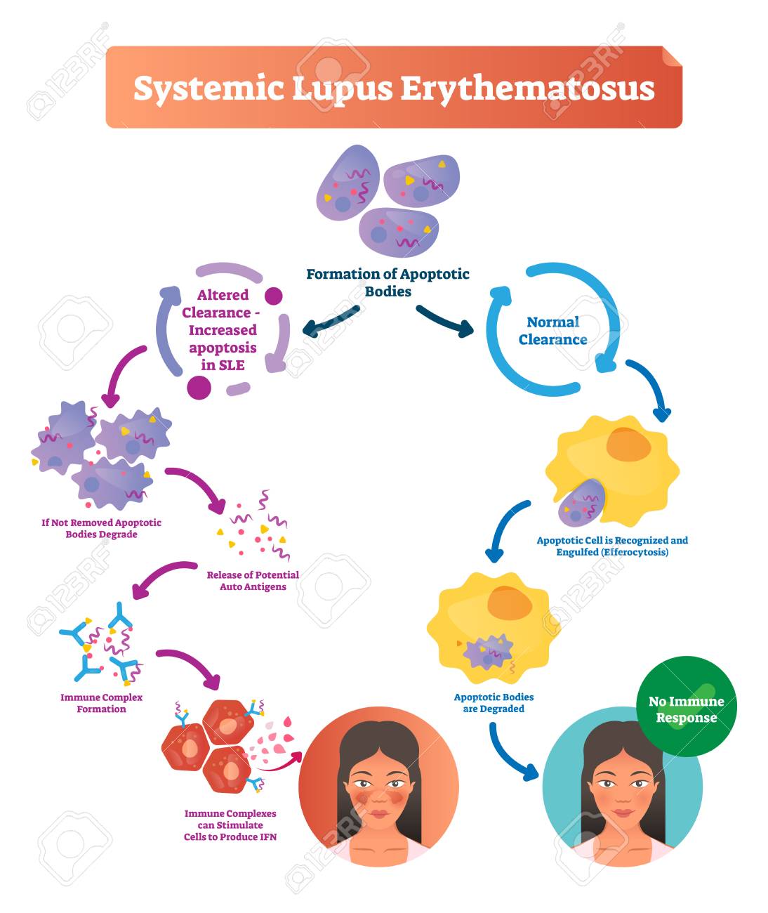 Systemic lupus erythematosus labeled diagram with normal and sick patient. Scheme of apoptotic bodies formation, altered clearance, bodies degradation and stimulation. - 139354620 Systemic lupus erythematosus labeled diagram with normal and sick patient. Scheme of apoptotic bodies formation, altered clearance, bodies degradation and stimulation. - 139354620