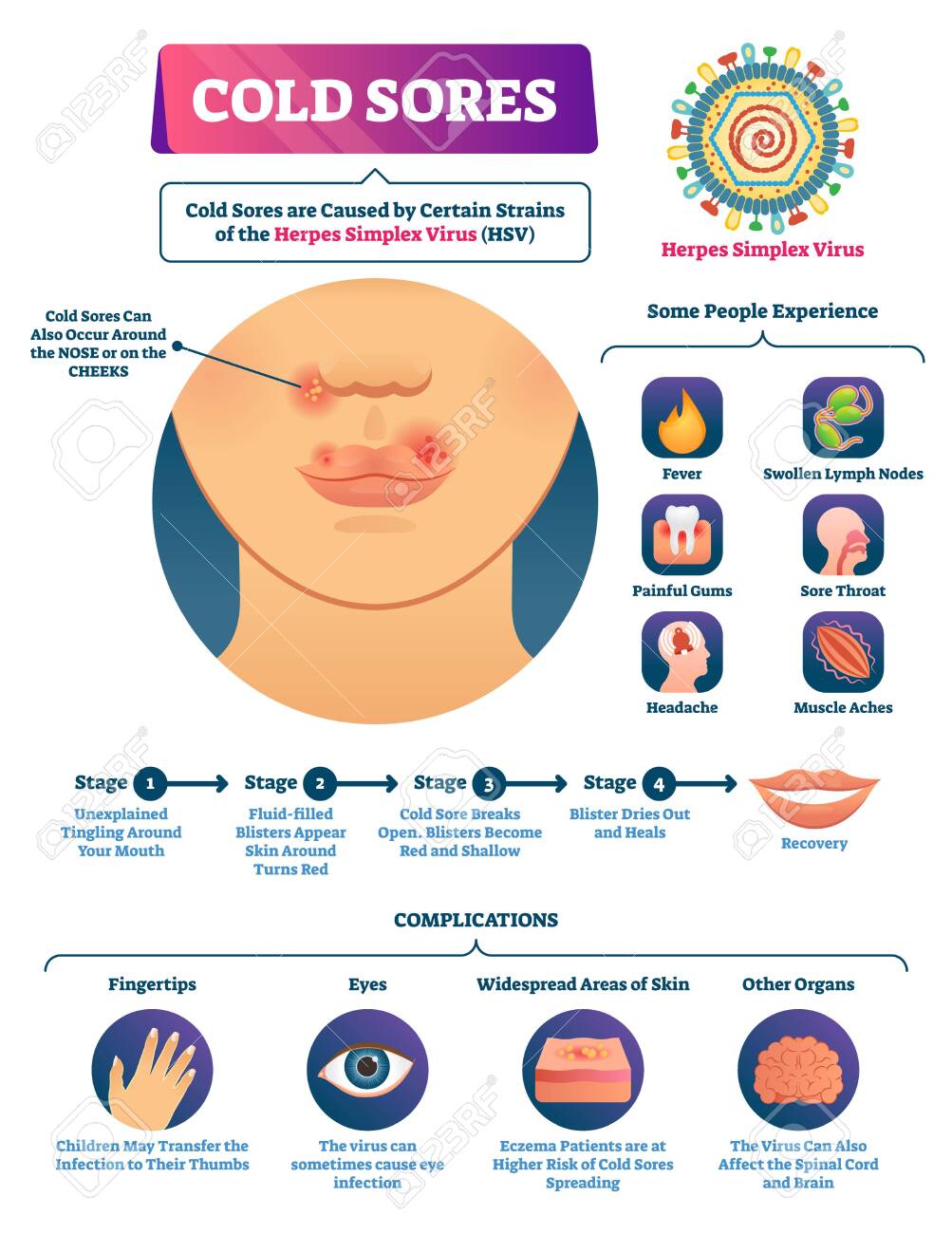 Cold Sores Vector Illustration. Medical Labeled Herpes Simplex Virus  Scheme. Anatomical Symptoms, Full Cycle Stages Collection And Disease  Complications. Nose And Cheeks Tingling Feeling Explanation. Клипарты, SVG,  векторы, и Набор Иллюстраций Без