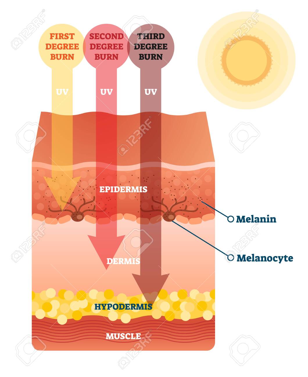 Sunburn Skin Damage Anatomical Cross Section Diagram Medical Problem Explanation Scheme Uv Light Impact On Epidermis Dermis And Hypodermis Layers Cancer Risk Caution And Health Danger Awareness Royalty Free Cliparts Vectors And