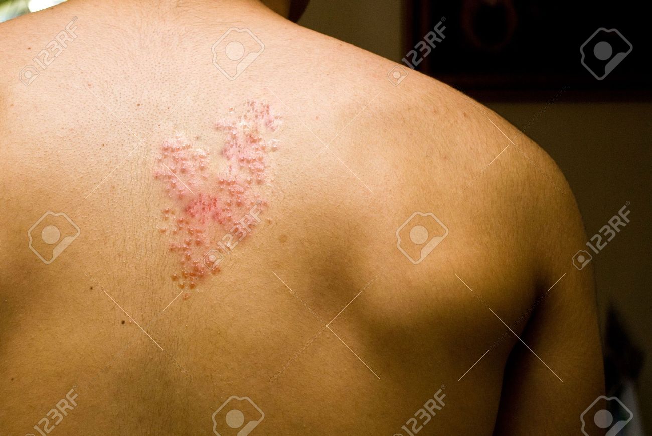 ウイルス感染症 帯状疱疹 ヘルペス帯状疱疹 の写真素材 画像素材 Image