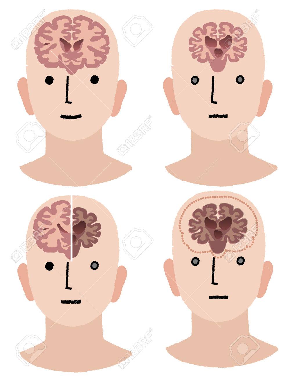volumen del cerebro e inteligencia