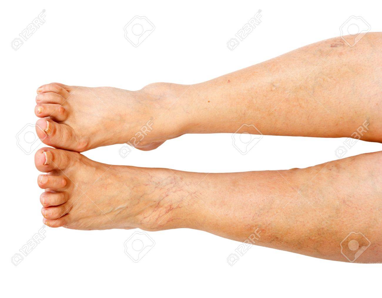 痛み 腫れ 静脈の拡張と慢性静脈不全 の写真素材 画像素材 Image