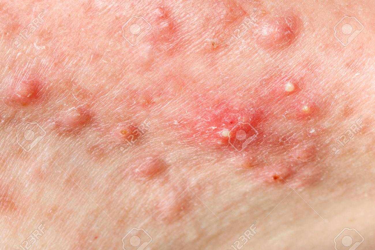 nodular acne