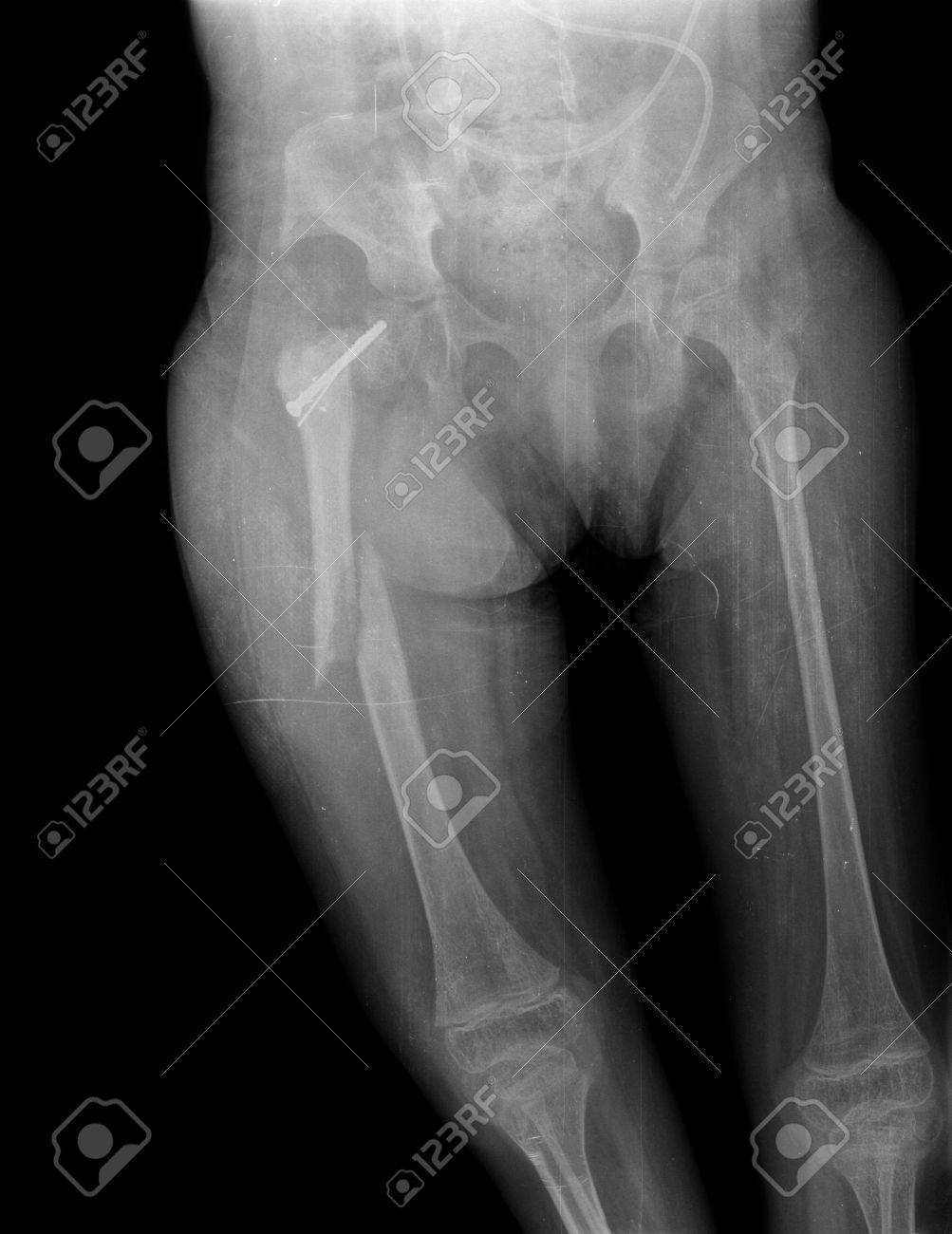 Broken Leg Of Child Xray Stock Photo, Picture and Royalty Free Image. Image  34465774., image size:1003x1300