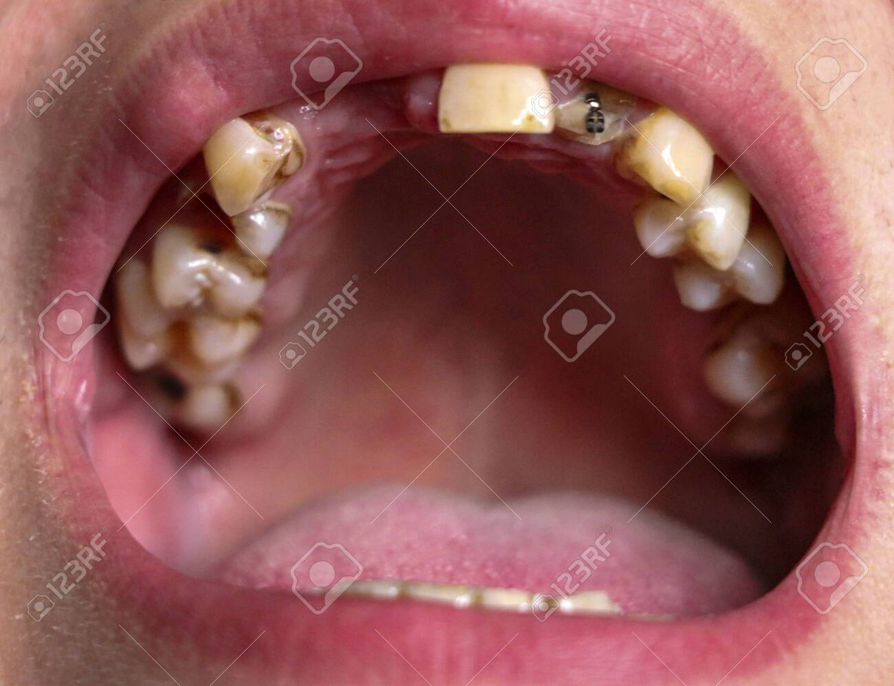 Teeth Coated With Nicotine Plaque