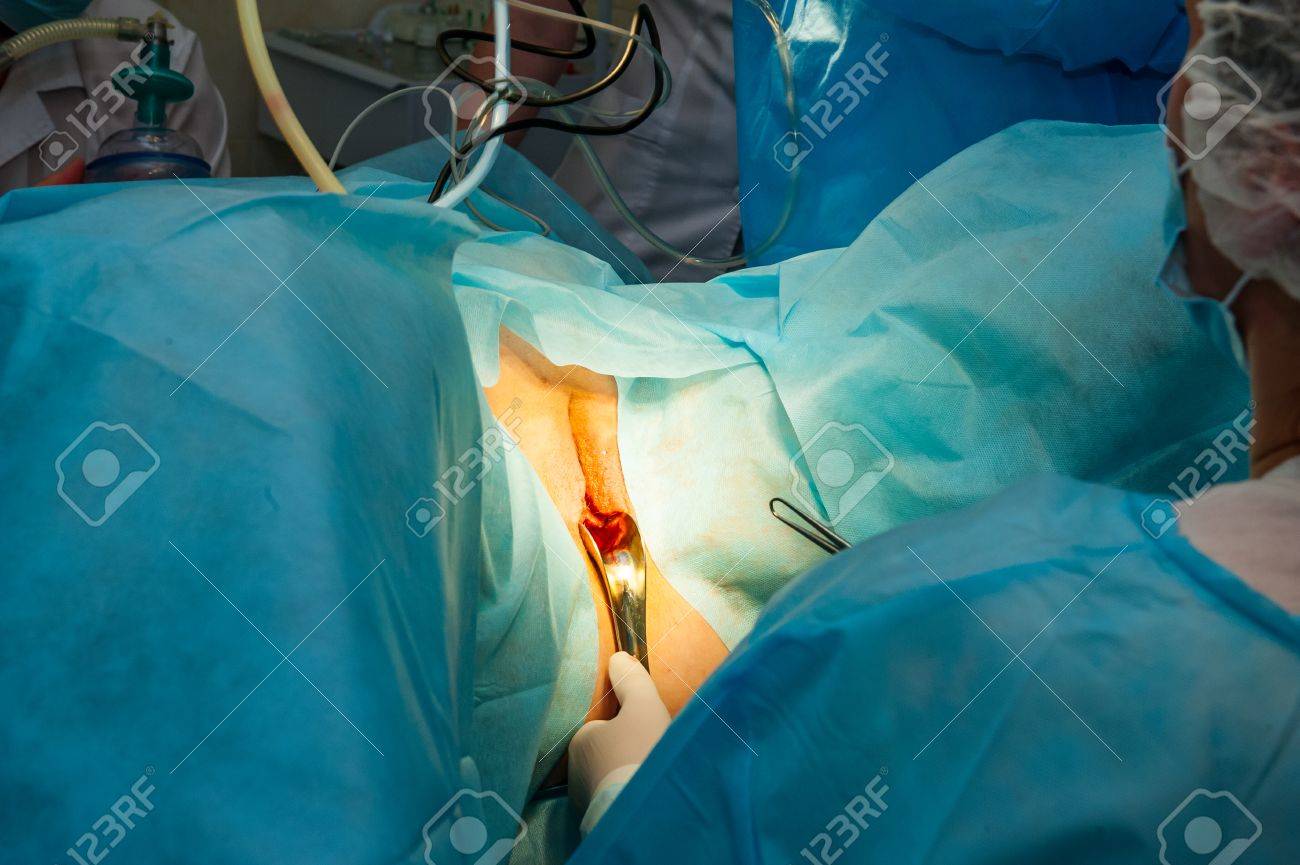 よりよい婦人科手術のための器具の使い方 : この操作ではこの手術器具