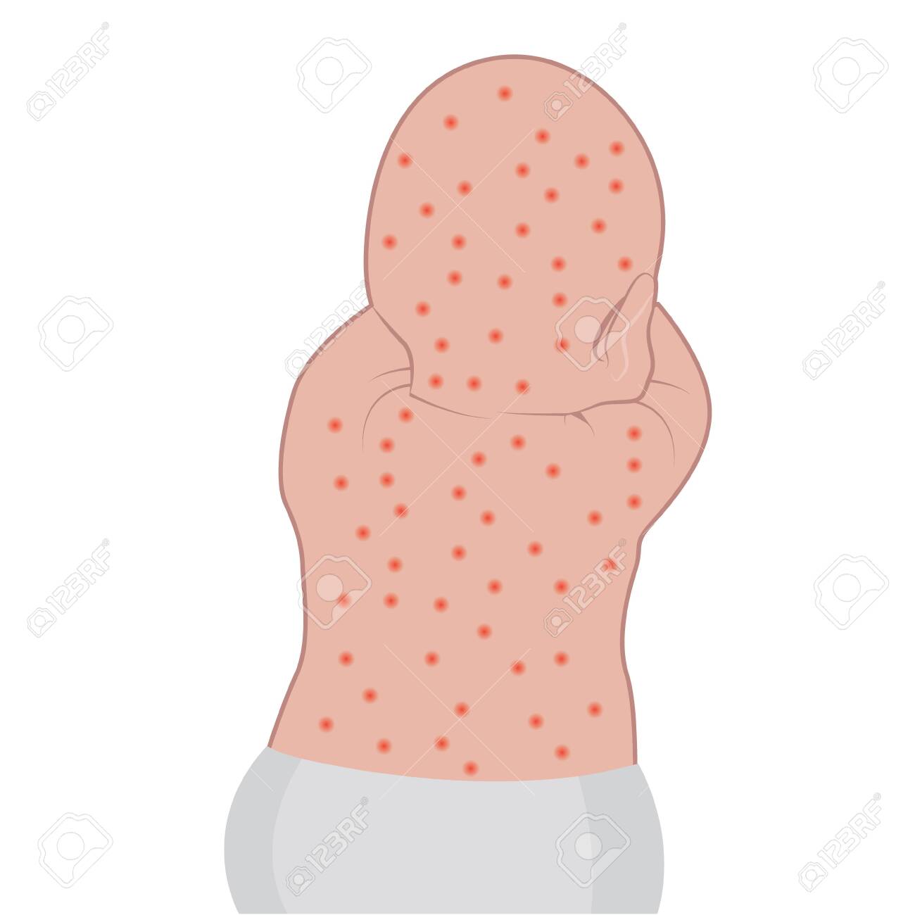 Baby S Back Affected With Eczema Skin Disease Vector Illustration Dermatology Problem Royalty Free Cliparts Vectors And Stock Illustration Image 131984597