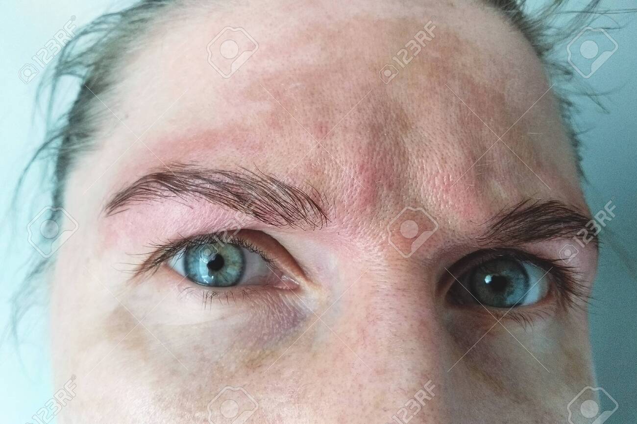 melasma facial