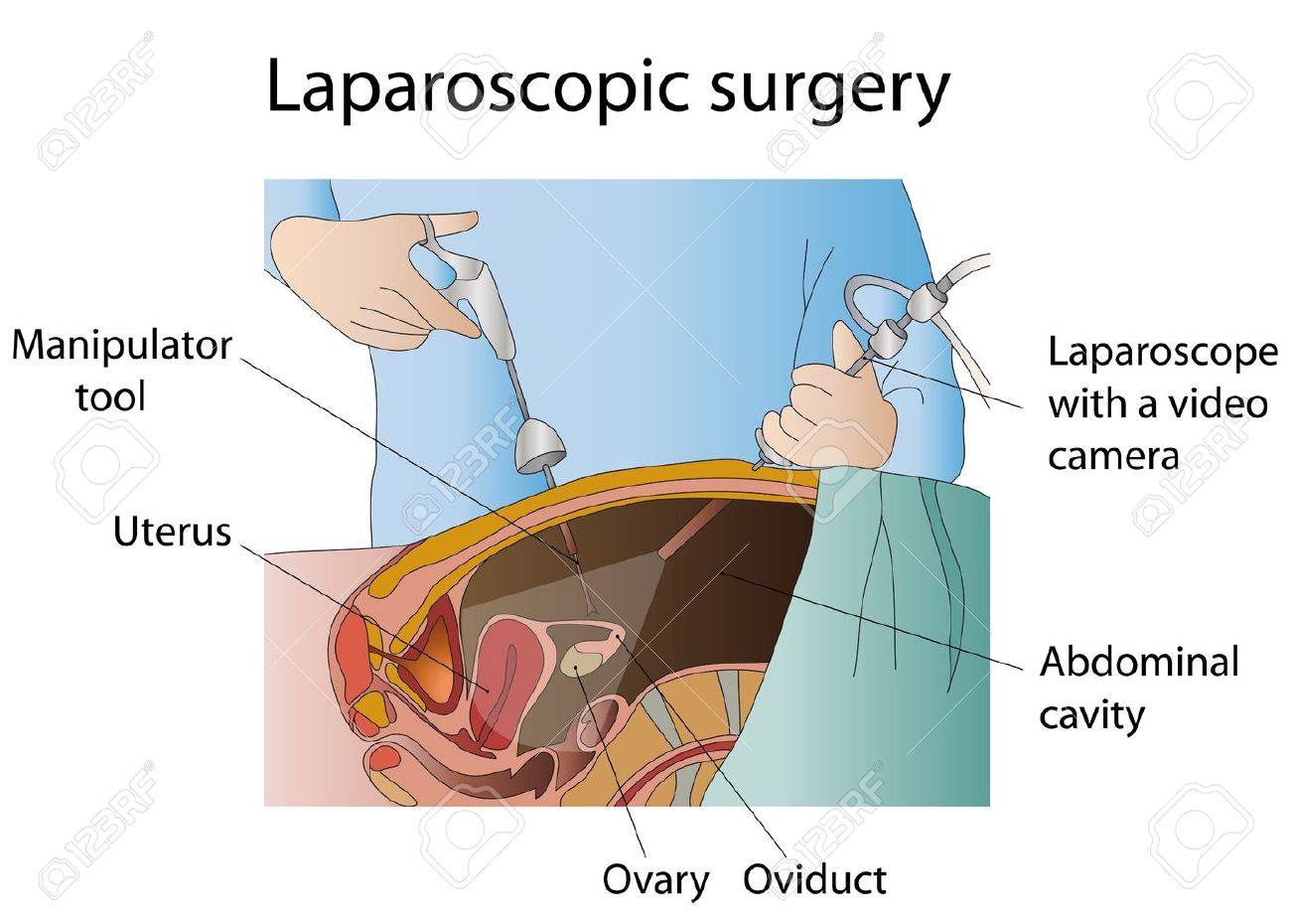 AI Enhances Prediction of Hospital Stays Post-GI Surgery