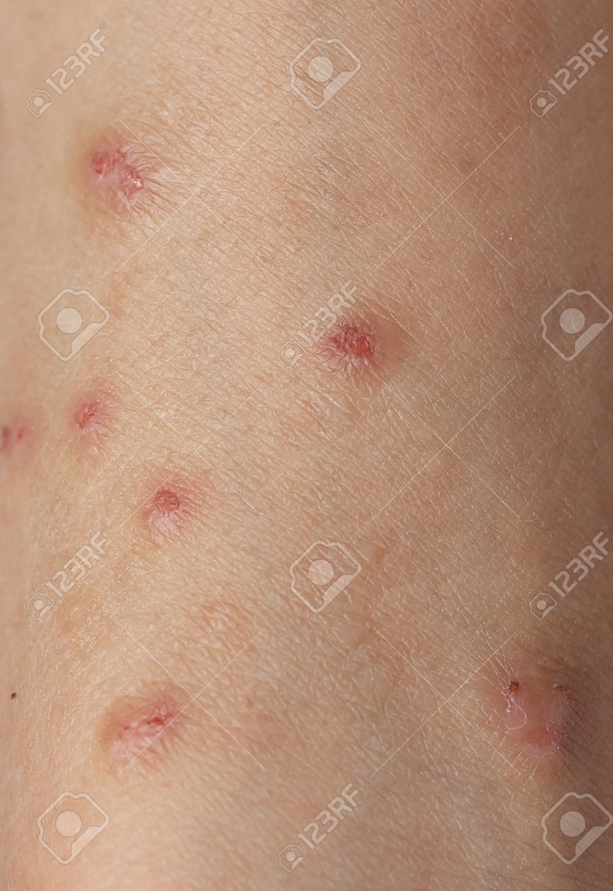 Lésions Cutanées Qui Démangent Dallergies Les Femmes De La Peau - 