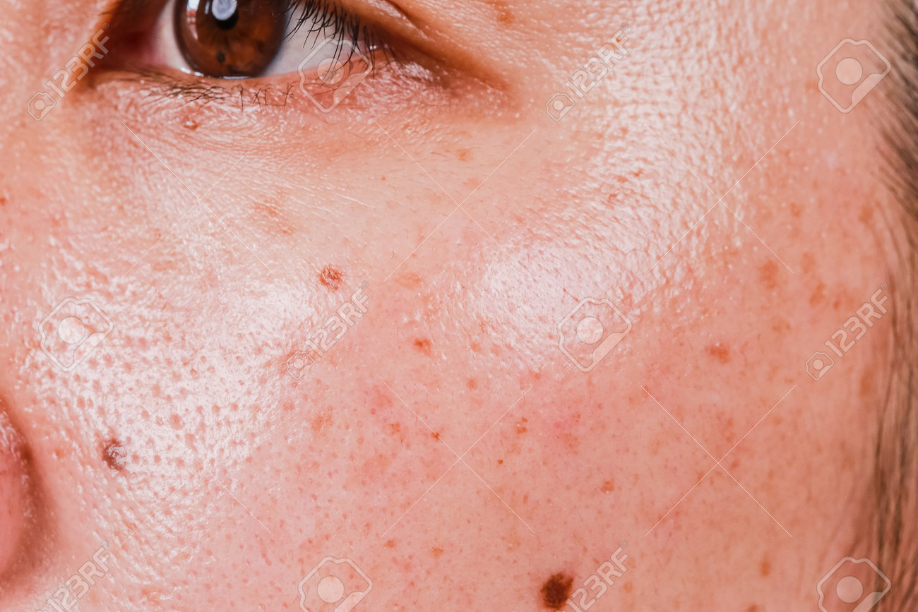 Common Skin Problems in Midlife