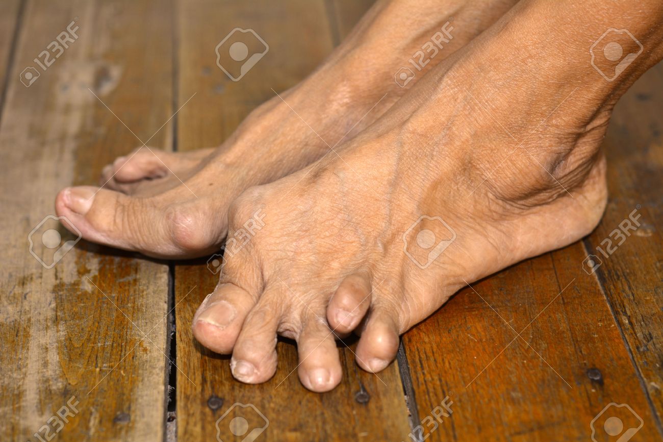 Le Pied De La Vieille Femme Deformee De L Arthrite Rhumatoide Ou
