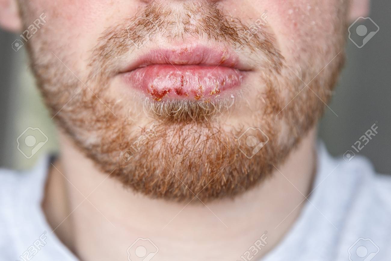 close up of herpes on lips cold of man dermatological oral skin lip diseases