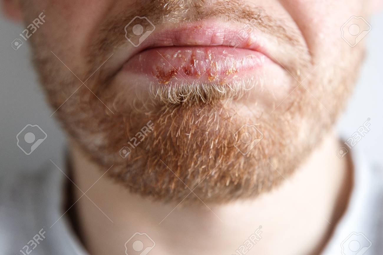 close up of herpes on lips cold of man dermatological oral skin lip diseases