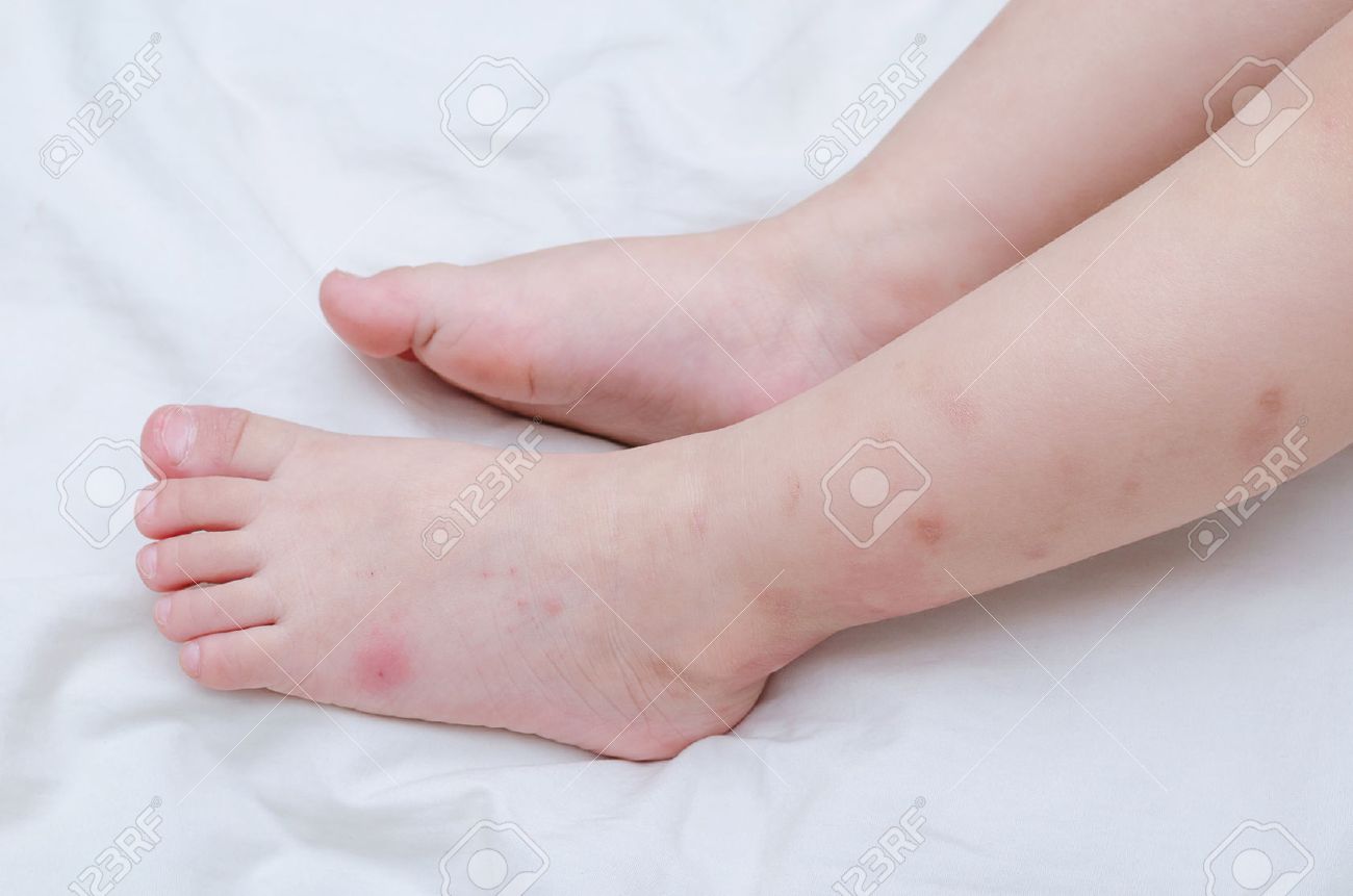 Les Piqures De Moustiques Plaie Sur Les Jambes De Bebe Banque D Images Et Photos Libres De Droits Image