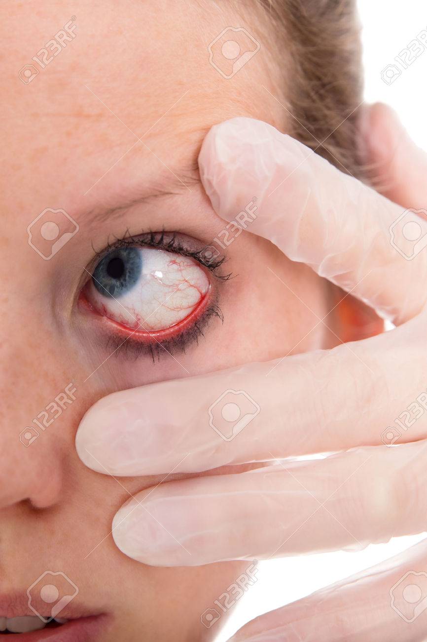 Gros Plan D Un Oeil Feminin Avec La Conjonctivite Banque D Images Et Photos Libres De Droits Image