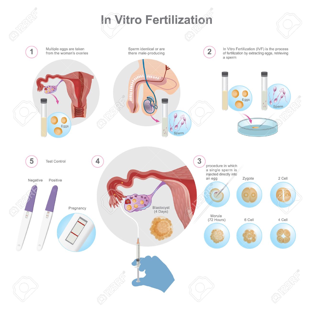 In Vitro Fertilization Is A Process Of Fertilisation Where An Egg Is  Combined With Sperm Outside The Body, In Vitro (in Glass). Health Care  Education Infographic. Vector Design. Royalty Free SVG, Cliparts,, image size:1300x1300