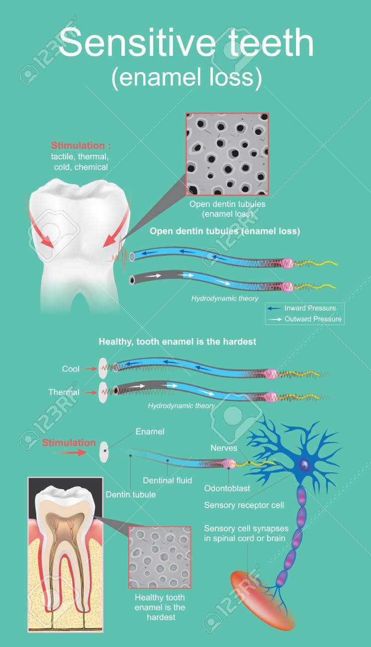 Sensitive dental is defined as intense and transitory pain that is cause by the exposure of the dentin. Vector graphic design. - 83031066 Sensitive dental is defined as intense and transitory pain that is cause by the exposure of the dentin. Vector graphic design. - 83031066