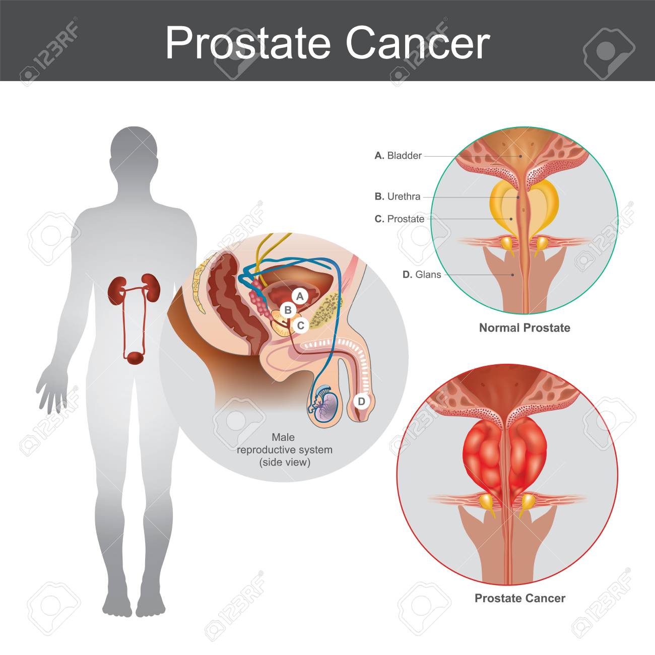 hombres prostata cancer