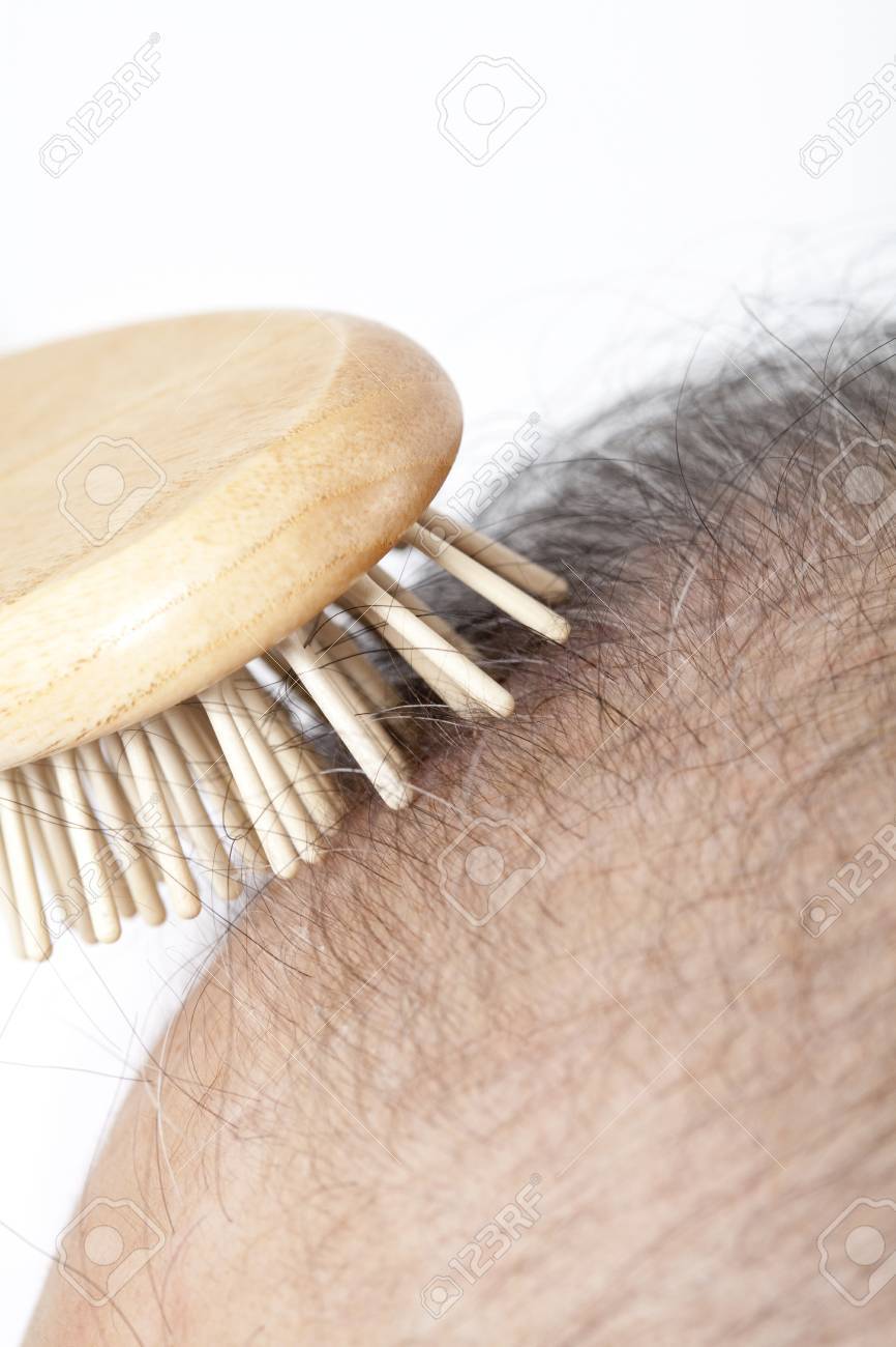 薄毛の男性のブラシで頭皮をタップします の写真素材 画像素材 Image