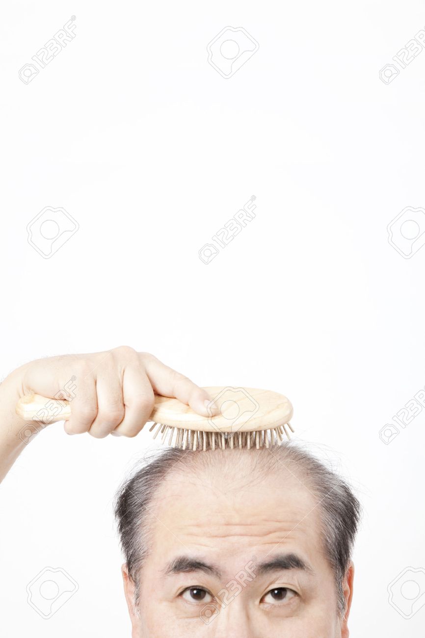 薄毛の男性のブラシで頭皮をタップします の写真素材 画像素材 Image