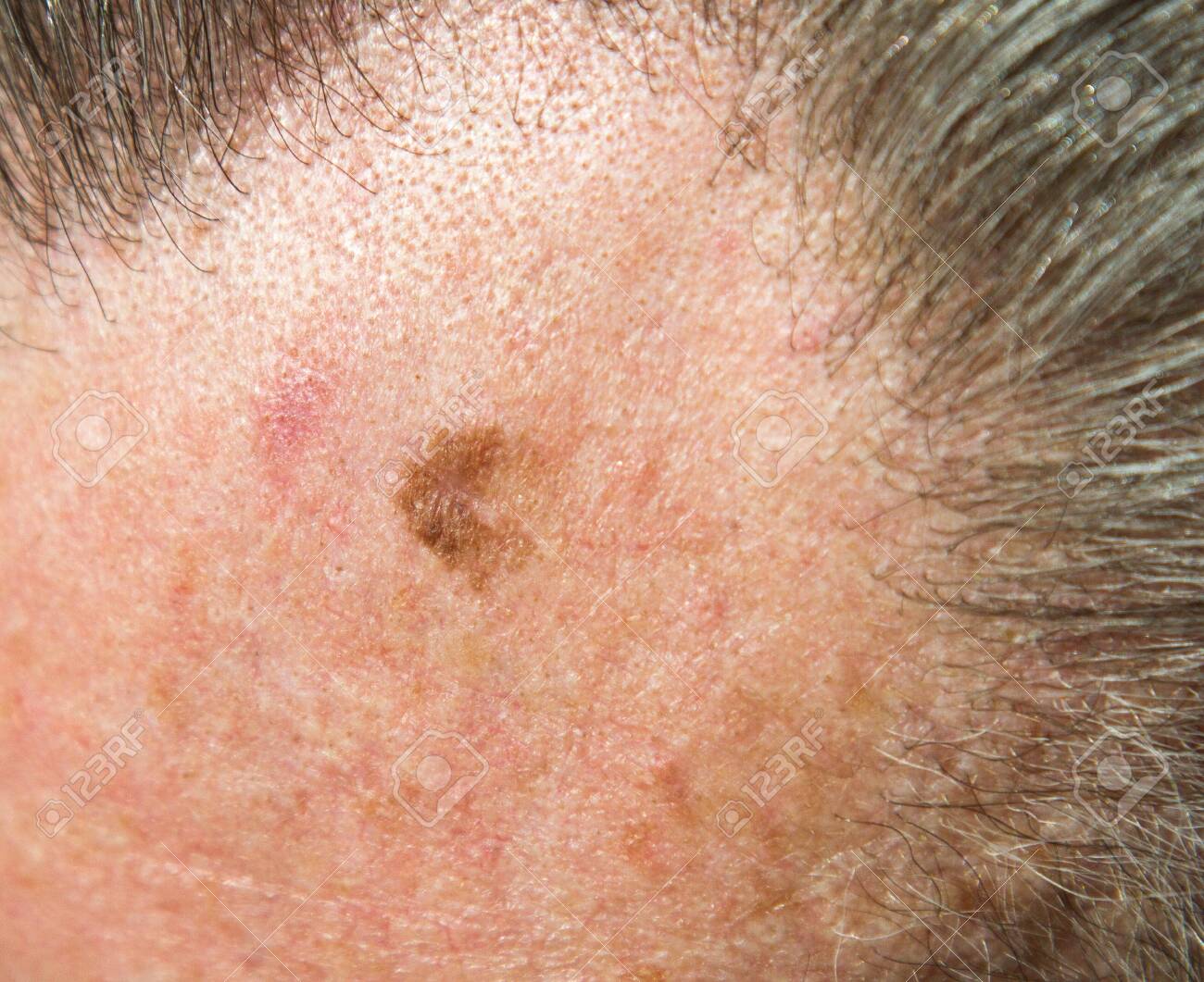 Lentigo Maligna Or Melanoma In Situ 64 Year Old Male Stock Photo Picture And Royalty Free Image Image