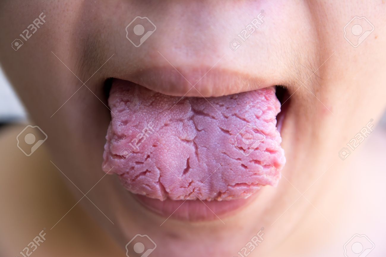 How to Heal a Sore Tongue: 11 Steps (with) How to Heal a Sore Tongue: 11 Steps (with)