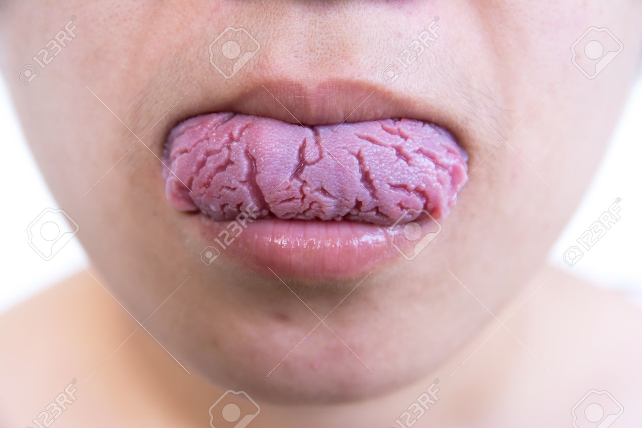 Tongue pictures thrush on of Tongue pictures thrush on of