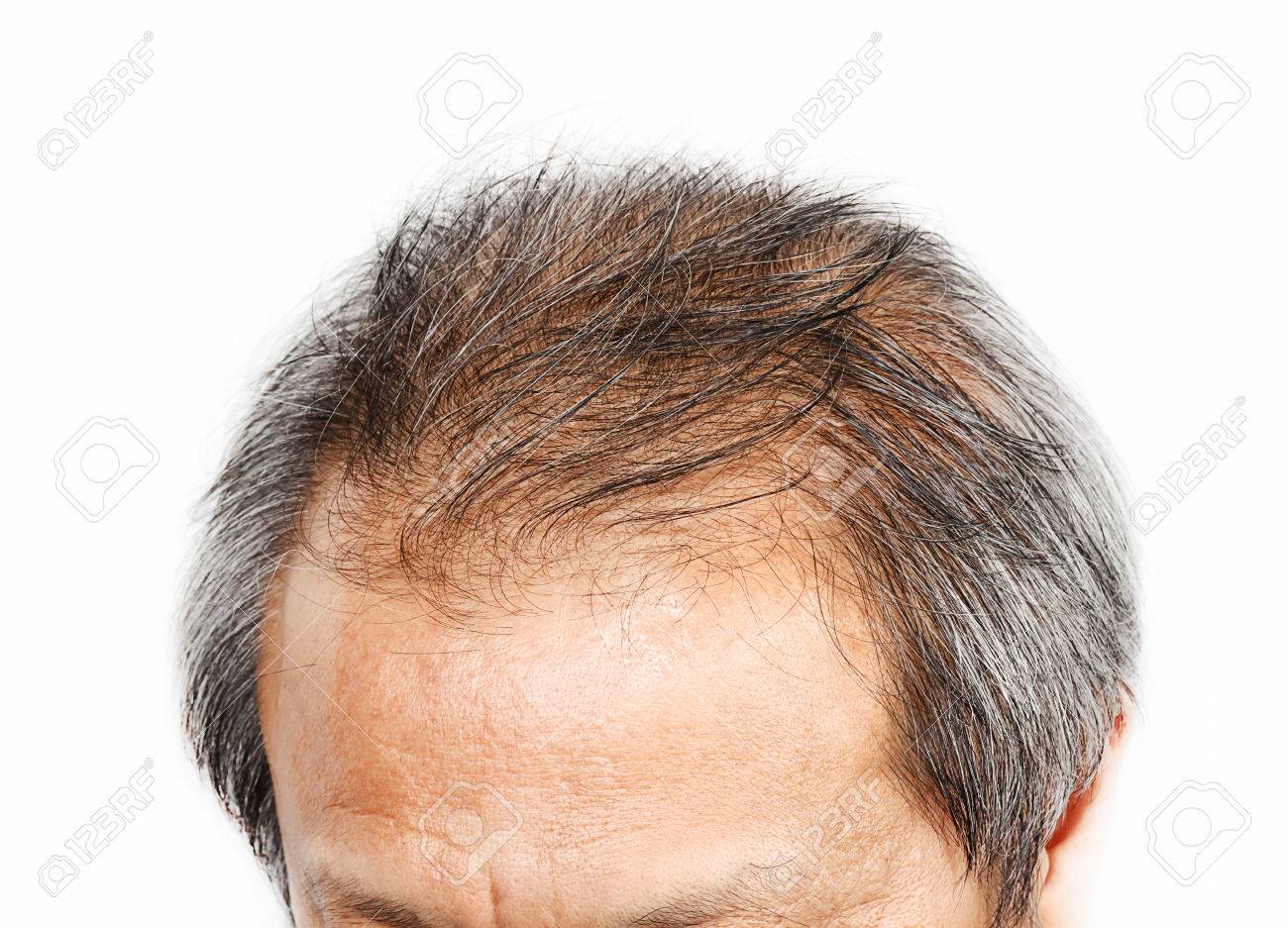 Male head with hair loss symptoms front side - 33223801 Male head with hair loss symptoms front side - 33223801