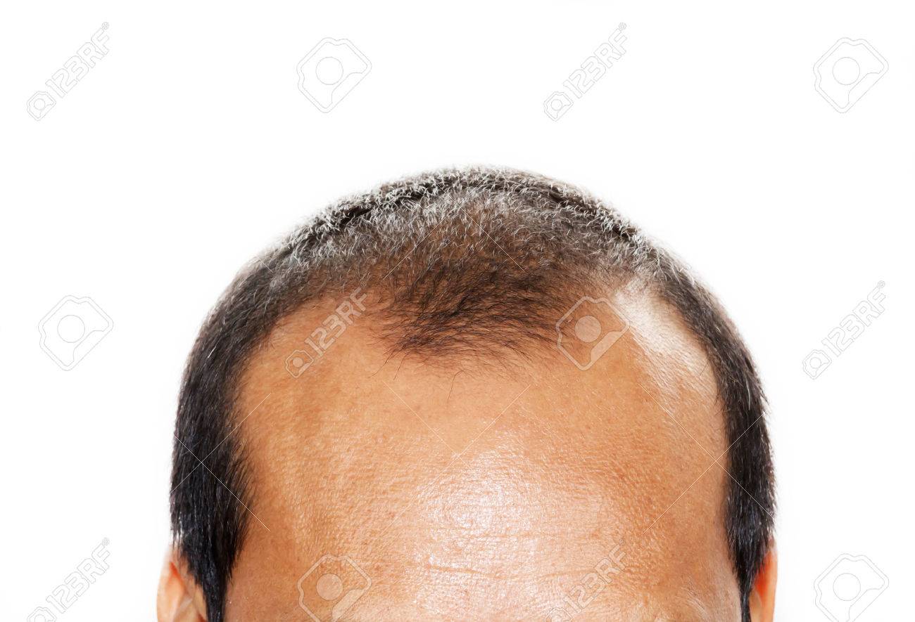 Male head with hair loss symptoms front side - 33224692 Male head with hair loss symptoms front side - 33224692