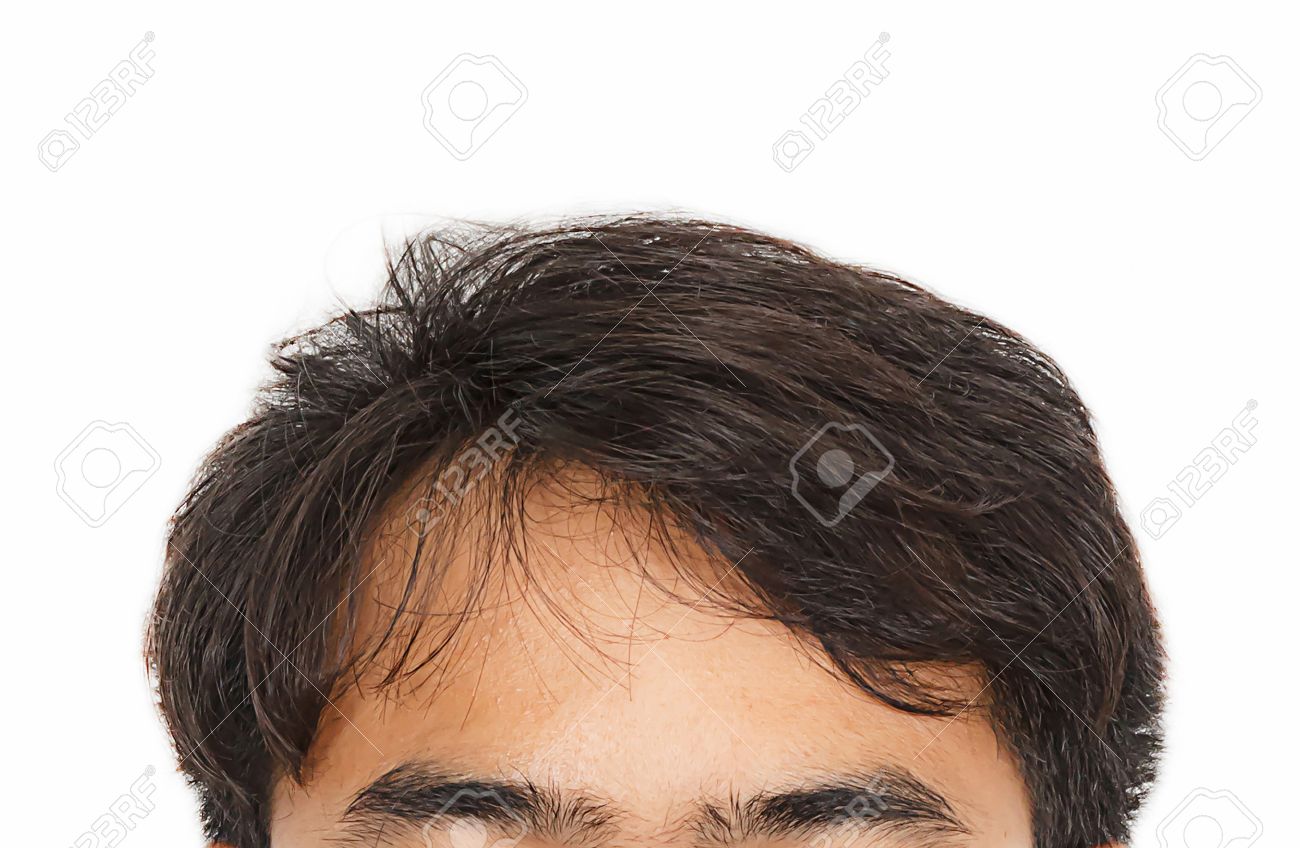 hair loss, Male head with hair loss symptoms front side - 38725717 hair loss, Male head with hair loss symptoms front side - 38725717